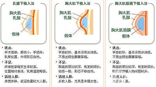 假體隆胸有哪些優(yōu)勢和缺點?為小白詳細(xì)解說