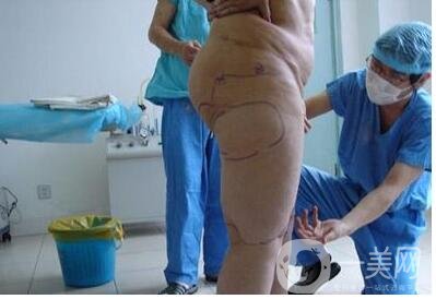 大腿抽脂多久恢復正常?恢復階段變化解說