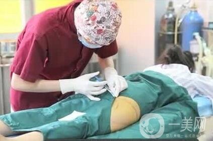 大腿抽脂多久恢復正常?恢復階段變化解說