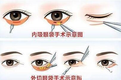 解答：不手術(shù)去眼袋的方法有沒有?是商家噱頭嗎?