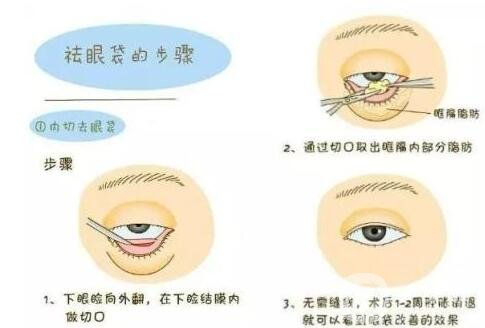 解答：不手術(shù)去眼袋的方法有沒有?是商家噱頭嗎?