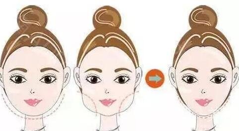 激光溶脂瘦臉后要注意什么啊?