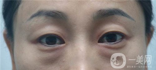 激光去眼袋的價(jià)格多少？要打幾次？