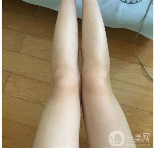 激光溶脂瘦大腿疼嗎？可以忍受嗎？