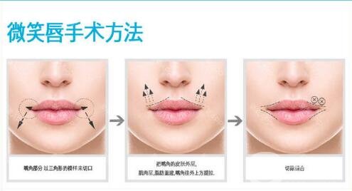 嘴角上揚(yáng)整形