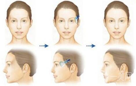 自體脂肪豐太陽穴