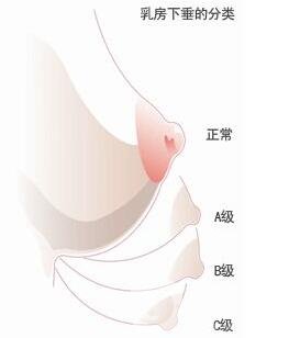 乳房下垂矯正后會反彈再次下垂嗎？術(shù)后穿什么內(nèi)衣？