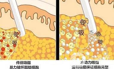 水動力吸脂減肥后為什么不會反彈?好處在哪兒?