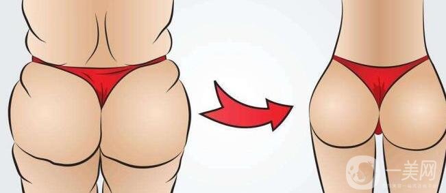 吸脂瘦臀之后幾天可以走動?