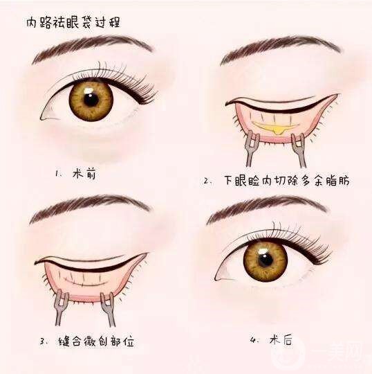 去眼袋,手術(shù),價格,是多少,與哪些因素有關(guān),