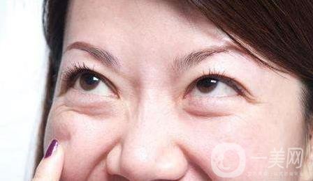 去眼袋,手術(shù),價格,是多少,與哪些因素有關(guān),