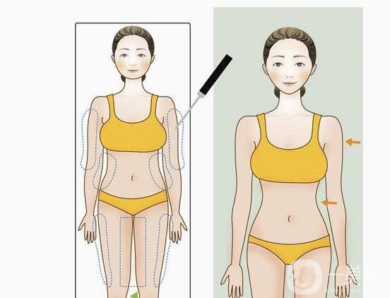 全身吸脂減肥好多錢？手術(shù)價格多少？