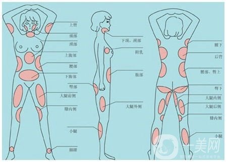 全身吸脂減肥危害大嗎？會(huì)不會(huì)死人？