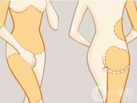 全身吸脂減肥危害大嗎？會(huì)不會(huì)死人？