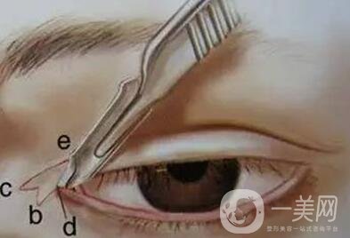 開眼角疤痕增生