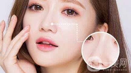 隆鼻后怎么消腫