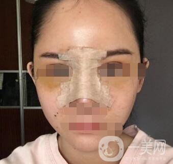 隆鼻固定膠帶幾天去掉？術(shù)后6天去掉會(huì)不會(huì)太早？