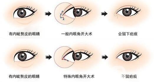 開(kāi)眼角前后照片圖，放大眼睛不是一點(diǎn)點(diǎn)