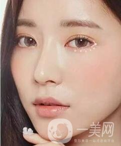 開(kāi)眼角前后照片圖，放大眼睛不是一點(diǎn)點(diǎn)