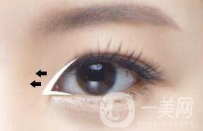 開眼角失敗怎么辦?還可以再修復(fù)嗎?