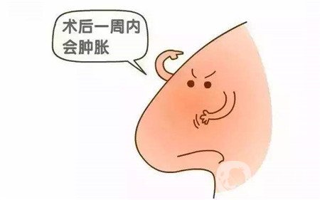 隆鼻手術(shù)恢復(fù)要多久才能自然？這期間要注意什么？