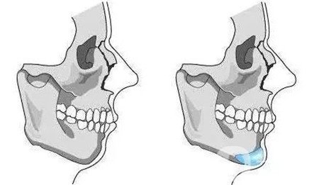 隆下巴假體硅膠好還是膨體好？