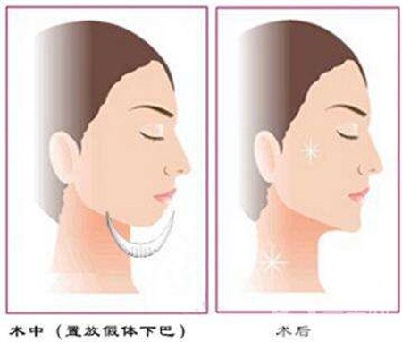 隆下巴假體歪了可以修復(fù)嗎？