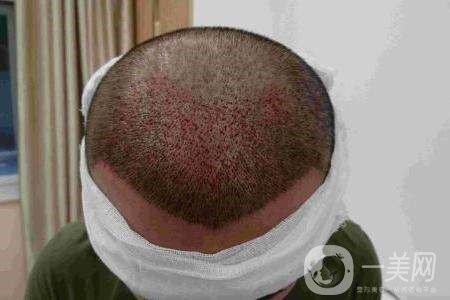 毛發(fā)種植費用大概要多少錢？