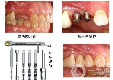 湖州種植牙多少錢 