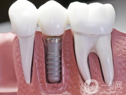 湖州種植牙多少錢 