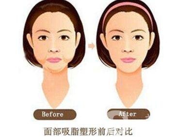 面部抽脂之后皮膚會變得松弛嗎？