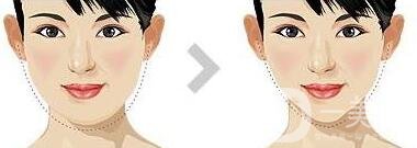 面部抽脂之后皮膚會變得松弛嗎？