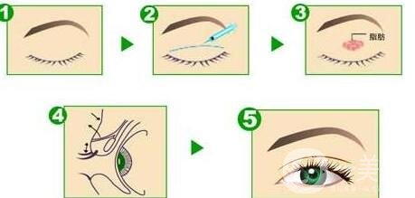 重慶哪里割雙眼皮比較好?選擇正規(guī)機(jī)構(gòu)認(rèn)準(zhǔn)這幾點(diǎn)!