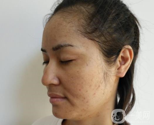 激光祛斑祛痘的后遺癥，你知道嗎？