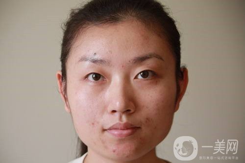 激光祛斑祛痘的后遺癥，你知道嗎？