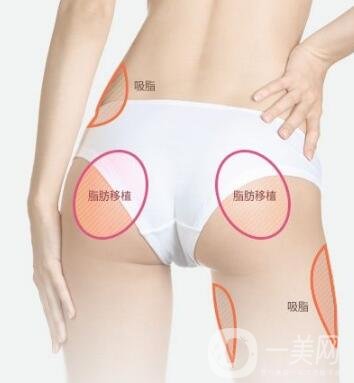 臀部吸脂手術(shù)