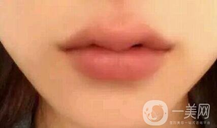 玻尿酸豐唇的*果 