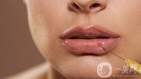 玻尿酸豐唇的*果 