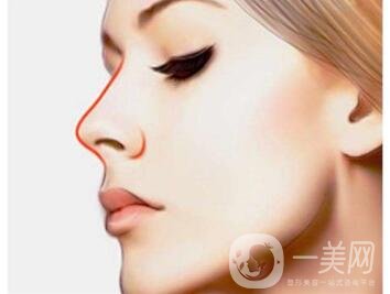 硅膠隆鼻修復(fù)換假體 