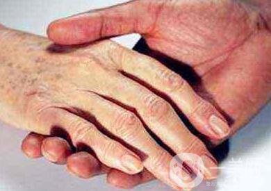 怎樣去掉手上的老年斑？還會再生嗎？