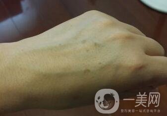 怎樣去掉手上的老年斑？還會再生嗎？