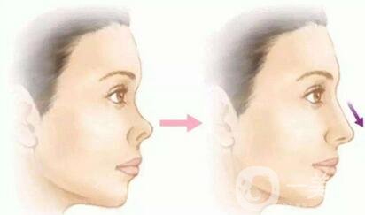 巫文云隆鼻技術(shù)到底好不好