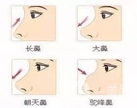 *多久才能笑自然?恢復(fù)期要多久?