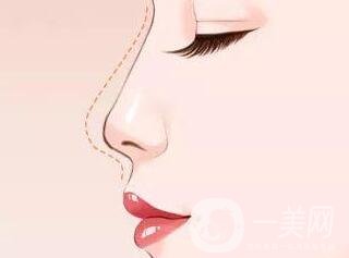 *多久才能笑自然?恢復(fù)期要多久?