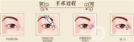 韓式開(kāi)眼角多少錢(qián)？普遍價(jià)位是多少？