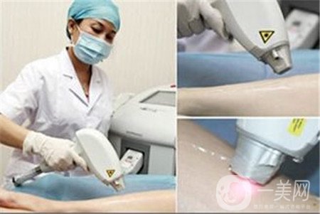 激光脫毛好嗎？有副作用嗎？