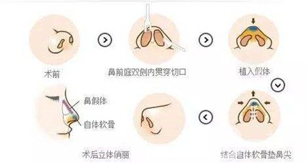 假體隆鼻多久可以修復(fù)?用什么材料修復(fù)?