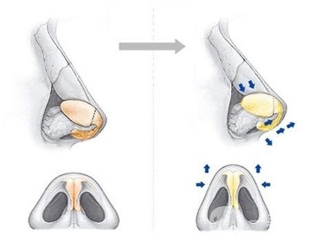 哪些人不適合硅膠隆鼻？禁忌人群是哪些？