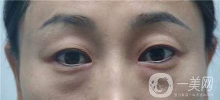 內(nèi)切去眼袋多長時間恢復?期間需要注意什么?