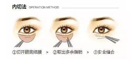 內(nèi)切去眼袋多長時間恢復?期間需要注意什么?